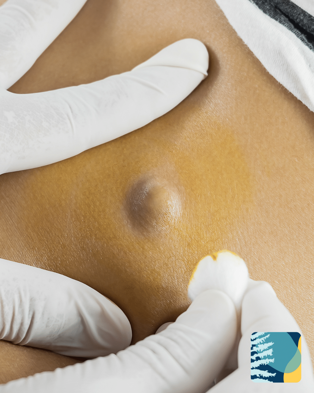 cyst-removal-manly.png